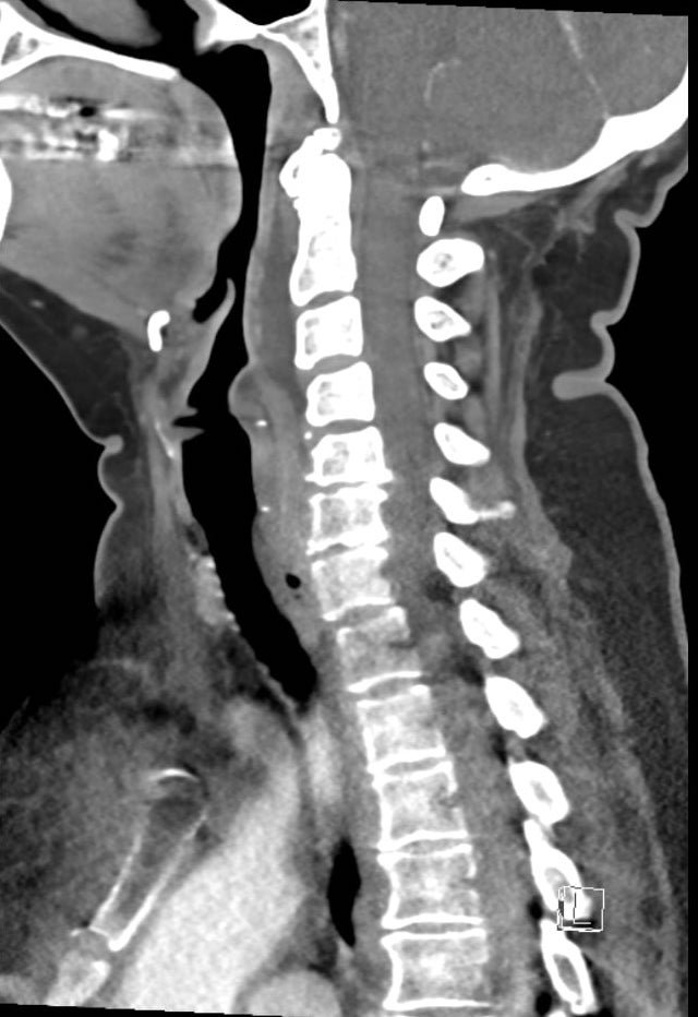 RPA Neck. CT Lateral. Unannotated. JETem 2025