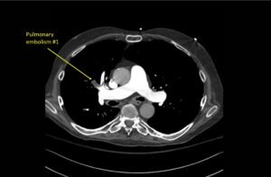 Wolff A et al. Right atrial thrombosis. CT axial 1