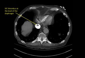 Wolff A et al. Right atrial thrombosis. CT axial IVC 2