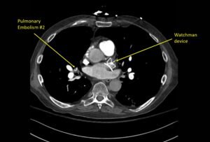 Wolff A et al. Right atrial thrombosis. CT axial PE 2