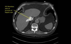 Wolff A et al. Right atrial thrombosis. CT axial juncture of hepatic vein