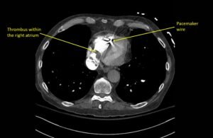 Wolff A et al. Right atrial thrombosis. CT axial right atrium