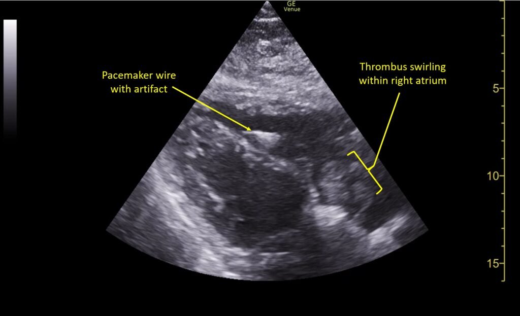 Wolff A et al. Right atrial thrombosis. Parasternal long US 3 annotated