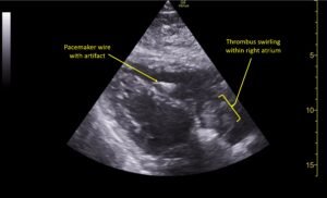 Wolff A et al. Right atrial thrombosis. Parasternal long US 3 annotated