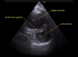 Wolff A et al. Right atrial thrombosis. Parasternal short US 1 annotated
