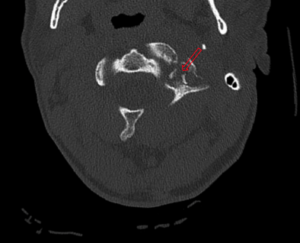 CSpine Fracture CT Axial Annotated. JETem 2025