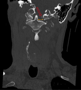 CSpine Fracture CT Coronal Annotated. JETem 2025