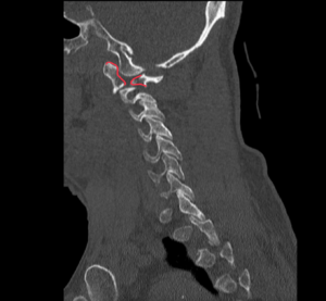 CSpine Fracture CT Sagital Annotated. JETem 2025