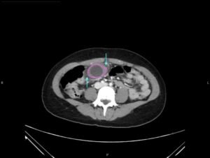Hydropic Gallbladder. CT Axial Annotated. JETem 2025