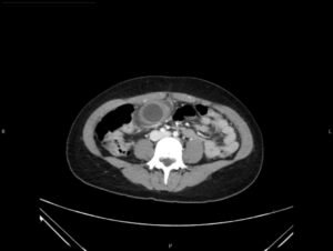 Hydropic Gallbladder. CT Axial Unannotated. JETem 2025