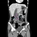 Hydropic Gallbladder. CT Coronal Annotated. JETem 2025