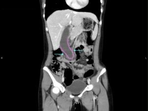 Hydropic Gallbladder. CT Coronal Annotated. JETem 2025
