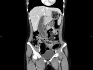 Hydropic Gallbladder. CT Coronal Unannotatd. JETem 2025