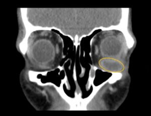 Inferior Rectus Abscess CT Coronal Annotated. JETem 2025