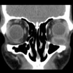 Inferior Rectus Abscess CT Coronal Unannotated. JETem 2025