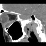 Inferior Rectus Abscess CT Sagital Unannotated. JETem 2025