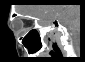 Inferior Rectus Abscess CT Sagital Unannotated. JETem 2025