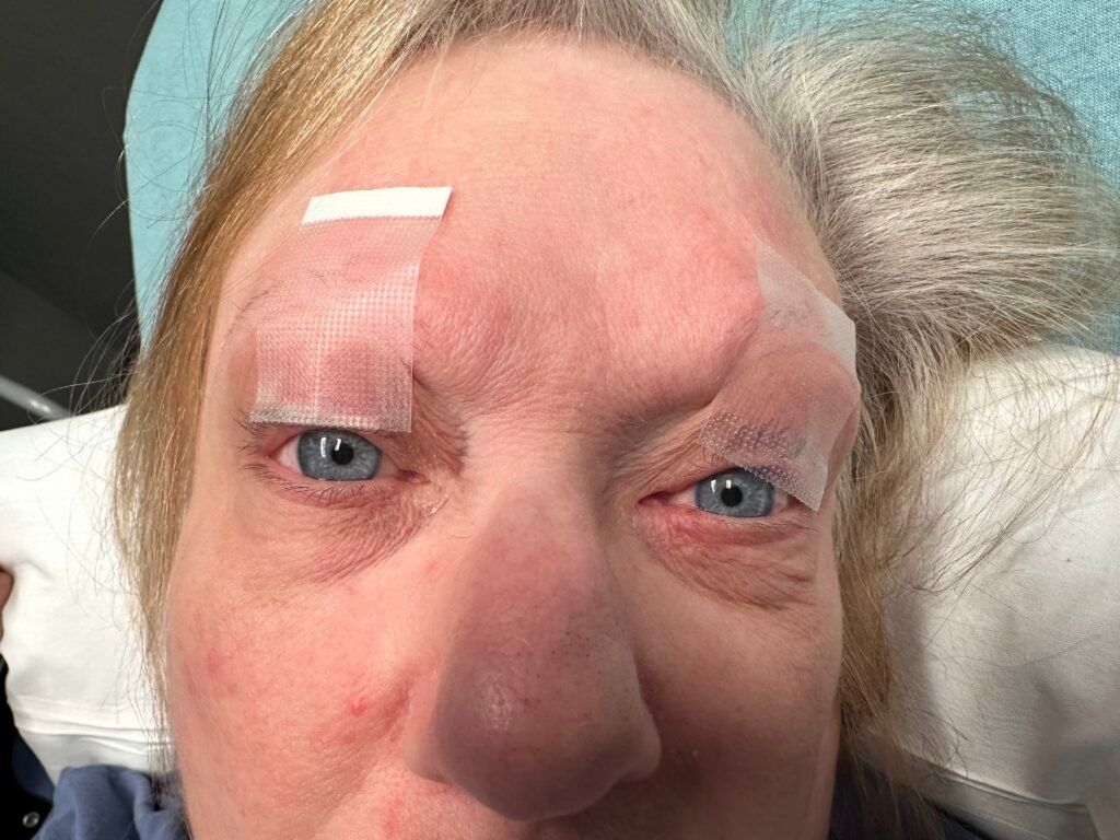 Myasthenia Gravis Eyes Taped Open. JETem 2025