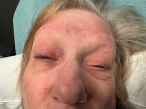 Myasthenia Gravis Eyes. JETem 2025