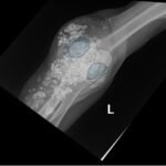 Calcinosis Cutis. Elbow XR AP Annotated. JETem 2025