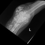 Calcinosis Cutis. Elbow XR AP. JETem 2025