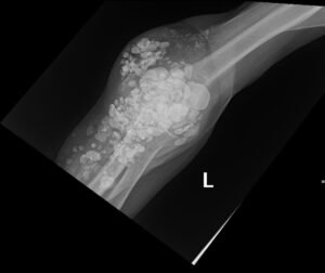 Calcinosis Cutis. Elbow XR AP. JETem 2025