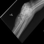 Calcinosis Cutis. Elbow XR External Oblique. JETem 2025