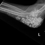 Calcinosis Cutis. Elbow XR Lateral. JETem 2025