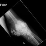 Calcinosis Cutis. Prior Elbow XR AP. JETem 2025