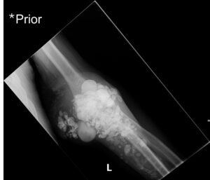 Calcinosis Cutis. Prior Elbow XR AP. JETem 2025