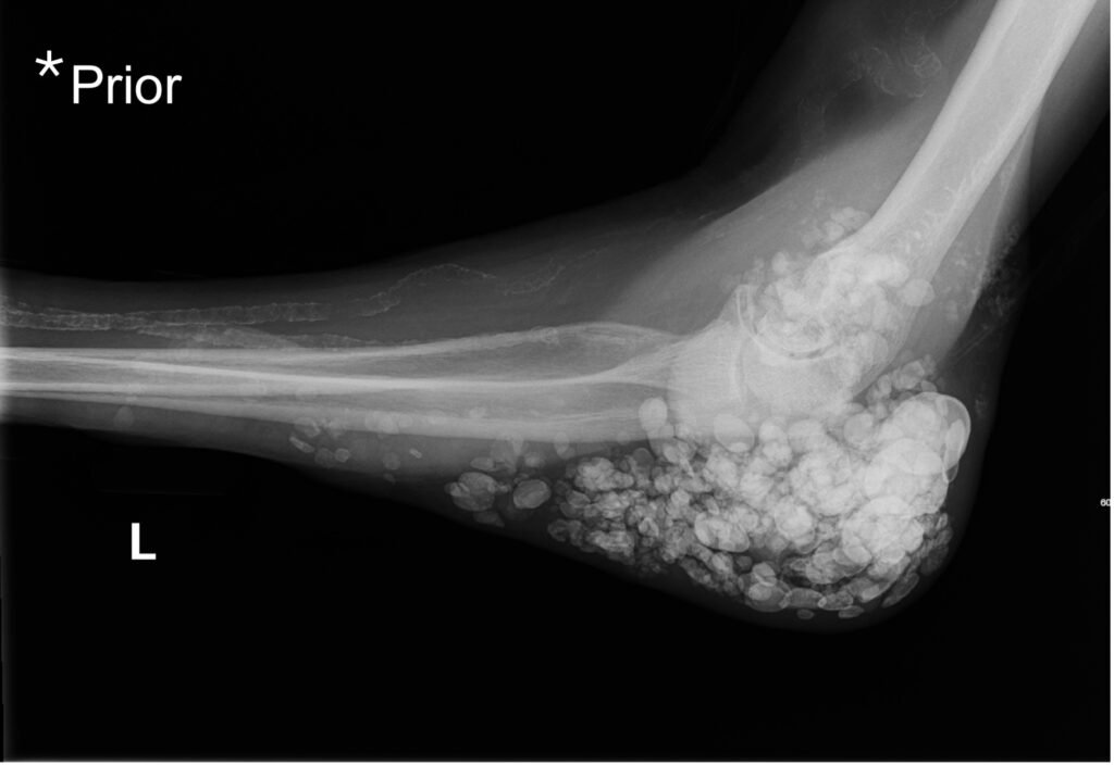 Calcinosis Cutis. Prior Elbow XR Lateral. JETem 2025