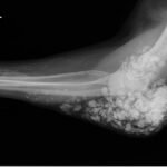 Calcinosis Cutis. Prior Elbow XR Lateral. JETem 2025