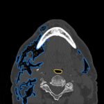 A Case Report of Facial Swelling and Crepitus Following a Dental Procedure 6 Dental Free Air CT Axial Annotated. JETem 2025