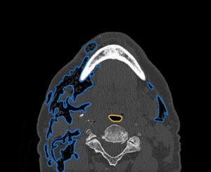 Dental Free Air CT Axial Annotated. JETem 2025