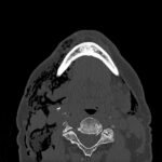 A Case Report of Facial Swelling and Crepitus Following a Dental Procedure 1 Dental Free Air CT Axial Unannotated. JETem 2025