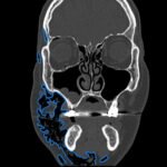 A Case Report of Facial Swelling and Crepitus Following a Dental Procedure 7 Dental Free Air CT Coronal Annotated. JETem 2025