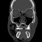 A Case Report of Facial Swelling and Crepitus Following a Dental Procedure 2 Dental Free Air CT Coronal Unannotated. JETem 2025