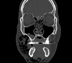 Dental Free Air CT Coronal Unannotated. JETem 2025