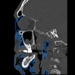 A Case Report of Facial Swelling and Crepitus Following a Dental Procedure 8 Dental Free Air CT Sagitial Annotated. JETem 2025