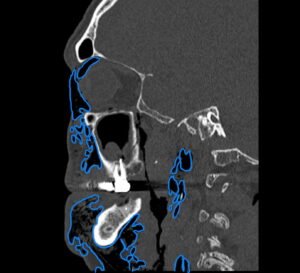 Dental Free Air CT Sagitial Annotated. JETem 2025