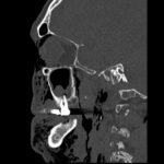 A Case Report of Facial Swelling and Crepitus Following a Dental Procedure 3 Dental Free Air CT Sagitial Unannotated. JETem 2025