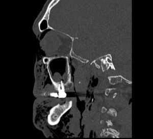 Dental Free Air CT Sagitial Unannotated. JETem 2025