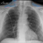 A Case Report of Facial Swelling and Crepitus Following a Dental Procedure 9 Dental Free Air CXR 2 Annotated. JETem 2025