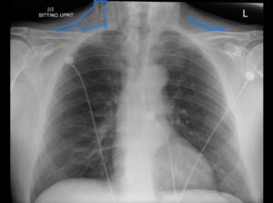 Dental Free Air CXR 2 Annotated. JETem 2025