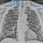 A Case Report of Facial Swelling and Crepitus Following a Dental Procedure 10 Dental Free Air CXR 2 Inverted Annotated. JETem 2025