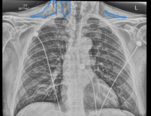 Dental Free Air CXR 2 Inverted Annotated. JETem 2025