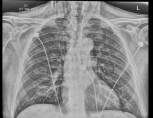 Dental Free Air CXR 2 Inverted Unannotated. JETem 2025