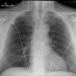 A Case Report of Facial Swelling and Crepitus Following a Dental Procedure 5 Dental Free Air CXR 2 Unannotated. JETem 2025