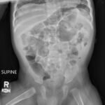 Incarcerated Gastric Volvulus and Splenic Herniation. Abdominal Radiograph Postoperative Day 33. JETem 2025