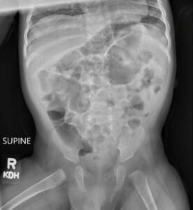 Incarcerated Gastric Volvulus and Splenic Herniation. Abdominal Radiograph Postoperative Day 33. JETem 2025